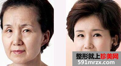 重庆拉皮除皱手术多少钱、拉皮除皱的价格怎么样