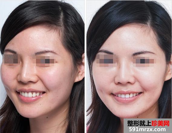 柳州美白针价格多少钱、美白针效果怎么样