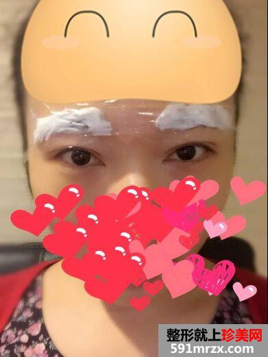 韩式半永久纹眉后不用再画眉啦