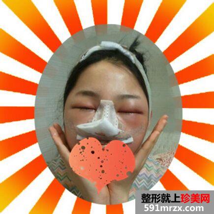 颧骨整形+隆鼻变得更加时尚靓丽