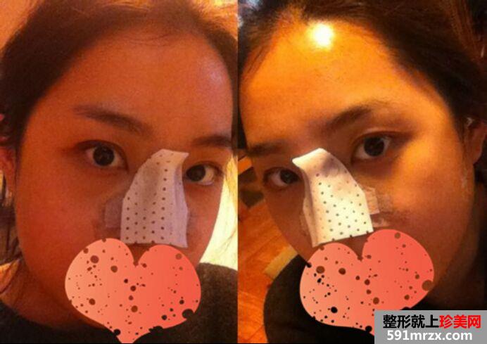 颧骨整形+隆鼻变得更加时尚靓丽