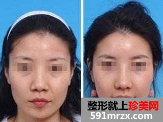深圳做隆鼻失败修复贵吗、隆鼻修复多少钱