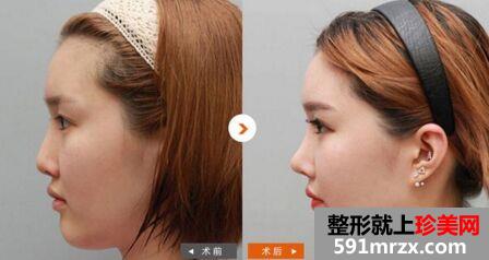 杭州鼻综合整形价格抢先看 