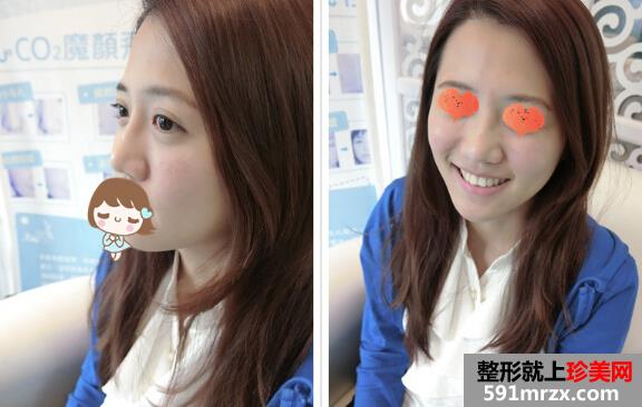 打玻尿酸后 苹果肌饱满鼻子也变翘了！