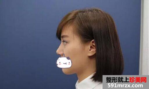 玻尿酸隆鼻后鼻梁立马变高挺~