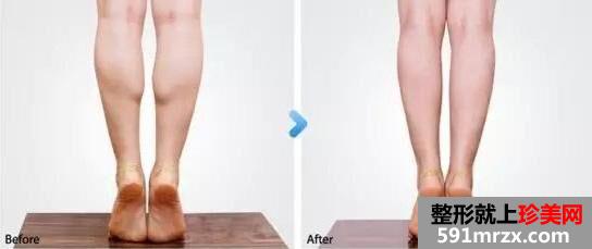 广州打瘦腿针多少钱一针、瘦腿针价钱高吗