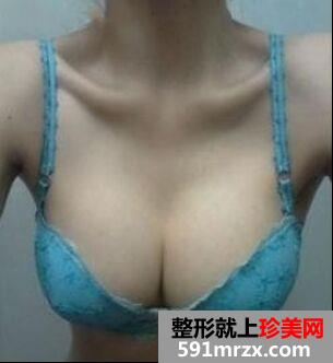 360cc硅胶假体隆胸让我平胸变丰满大胸