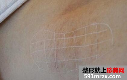 给大家看看脱腋毛过程 夏天可以穿美美的吊带衫了