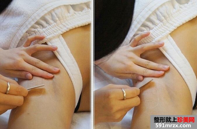 给大家看看脱腋毛过程 夏天可以穿美美的吊带衫了