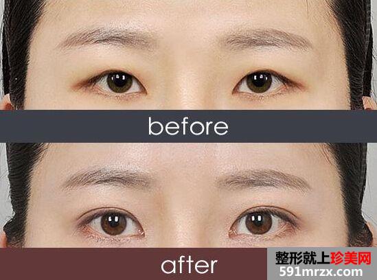 上海韩式三点双眼皮多少钱、效果怎么样