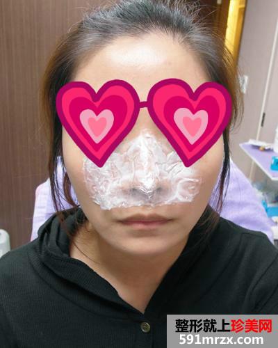 做完Misko隆鼻 颜值提升了许多