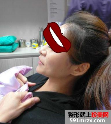 做完Misko隆鼻 颜值提升了许多
