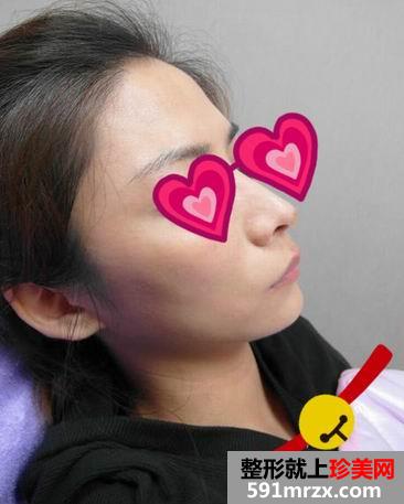 做完Misko隆鼻 颜值提升了许多