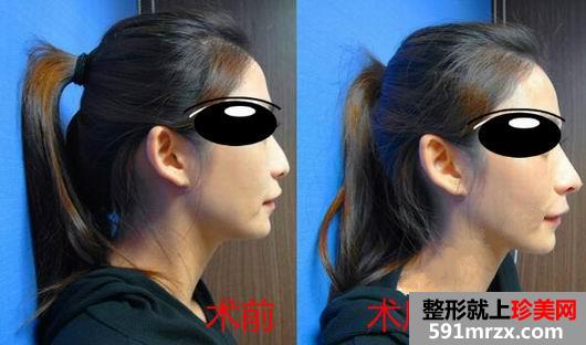 做完Misko隆鼻 颜值提升了许多