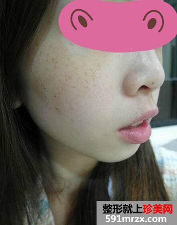 光子嫩肤去雀斑过程图+恢复图