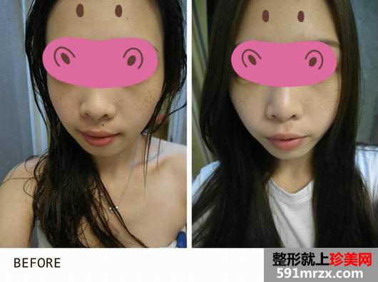 光子嫩肤去雀斑过程图+恢复图