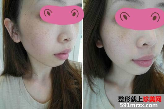 光子嫩肤去雀斑过程图+恢复图
