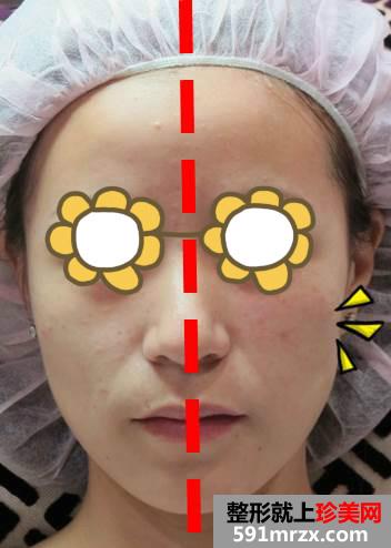 玻尿酸丰苹果肌+填充泪沟让宝妈恢复美丽面容