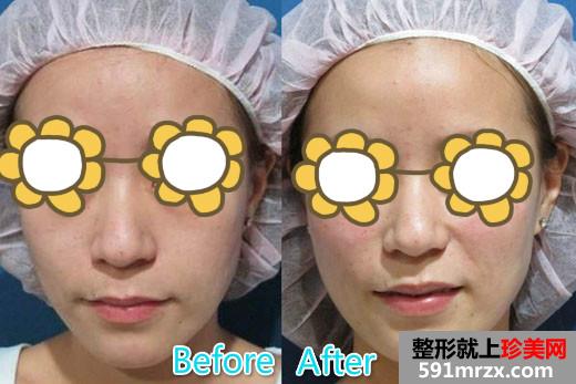 玻尿酸丰苹果肌+填充泪沟让宝妈恢复美丽面容