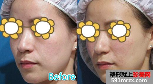 玻尿酸丰苹果肌+填充泪沟让宝妈恢复美丽面容