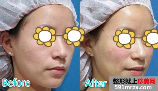 玻尿酸丰苹果肌+填充泪沟让宝妈恢复美丽面容