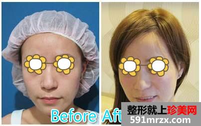 玻尿酸丰苹果肌+填充泪沟让宝妈恢复美丽面容