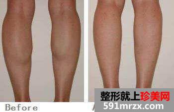 深圳打瘦腿针要多少钱、打瘦腿针有用吗