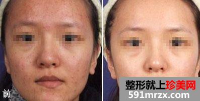 成都激光美容祛痘多少钱、激光美容祛痘的价格贵吗