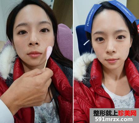 注射乔雅登玻尿酸去法令纹 前后对比图曝光