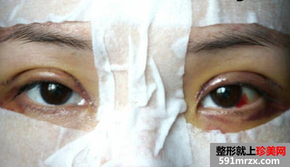 第二次做双眼皮手术 果然还是全切比较好