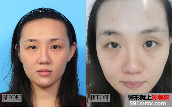 双眼皮修复手术案例 恢复非常棒 