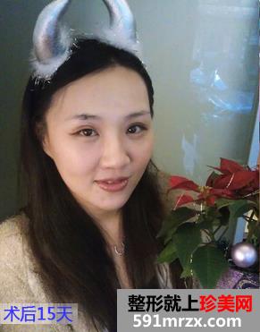 双眼皮修复手术案例 恢复非常棒 