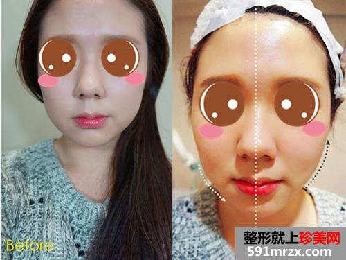 埋线提拉后小V脸更明显了 拍照不用再PS了！