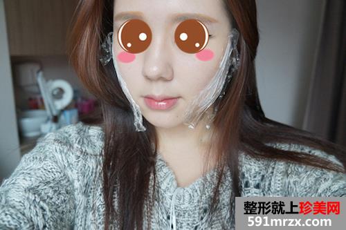 埋线提拉后小V脸更明显了 拍照不用再PS了！