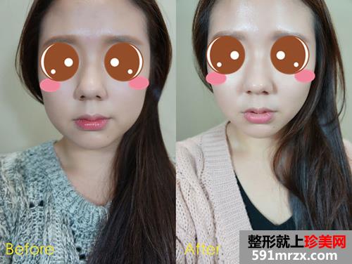 埋线提拉后小V脸更明显了 拍照不用再PS了！