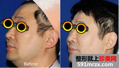 极线音波拉皮后大叔变小年轻