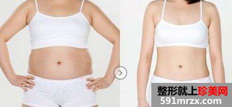 天津吸脂减肥手术多少钱、吸脂减肥价格贵吗