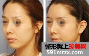 武汉自体脂肪填充下巴多少钱、效果好吗
