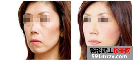 成都拉皮除皱多少钱、拉皮除皱效果如何