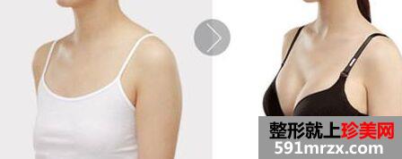 长沙做假体隆胸手术多少钱、费用贵吗