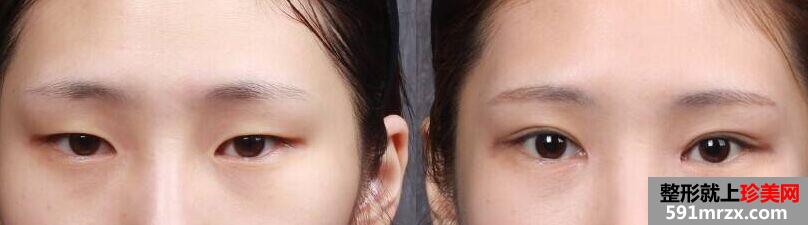 宁波割双眼皮手术多少钱