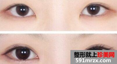 郑州双眼皮失败修复多少钱、费用多少