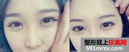 烟台做韩式双眼皮多少钱、效果好吗