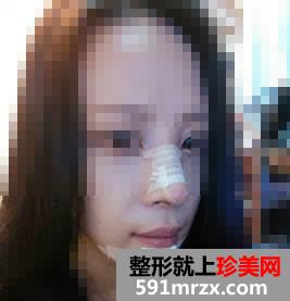 为变美做了隆鼻+垫下巴 效果非常好
