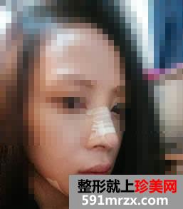 为变美做了隆鼻+垫下巴 效果非常好