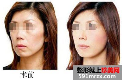厦门做拉皮除皱大概需要多少钱