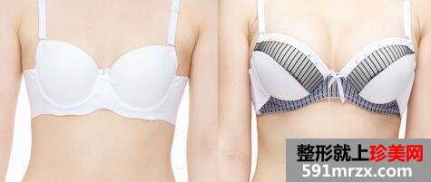 武汉曼陀假体隆胸需要多少钱、价格贵吗