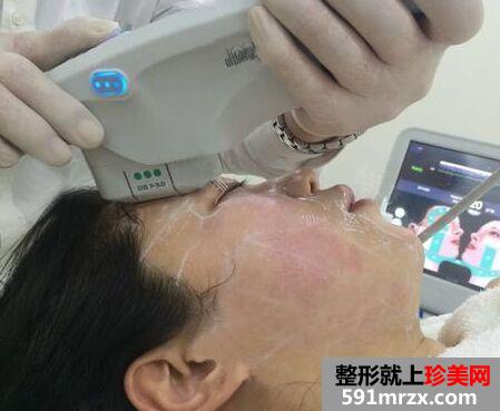 年龄大了做超声刀面部提升效果超棒