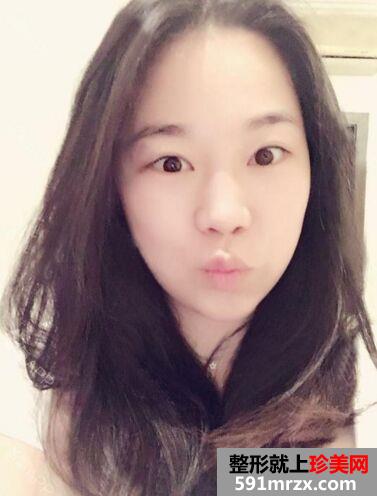 年龄大了做超声刀面部提升效果超棒