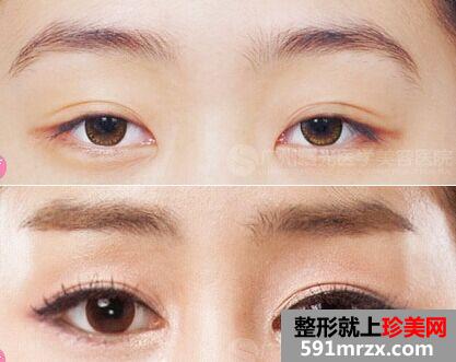 石家庄上睑下垂矫正价格、上睑下垂手术矫正多少钱
